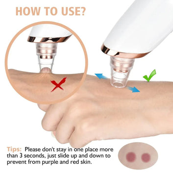 5-in-1 Blackhead Remover